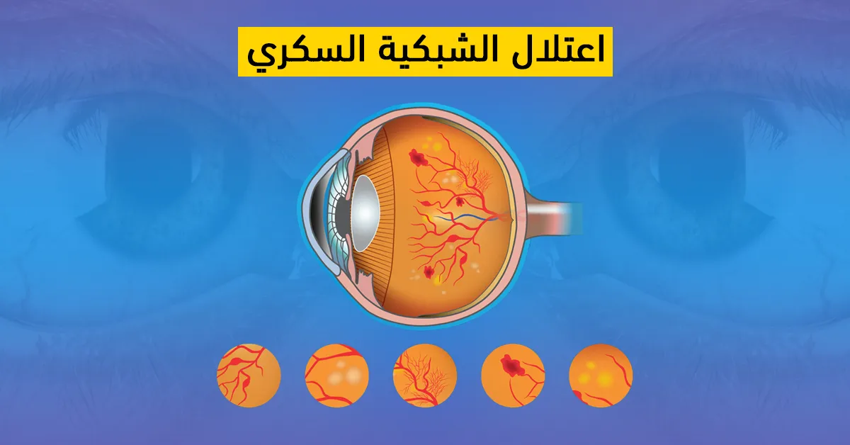 اعتلال الشبكية السكري